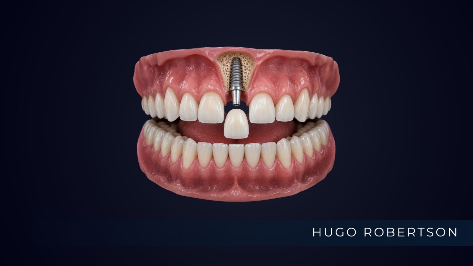 implante dente da frente