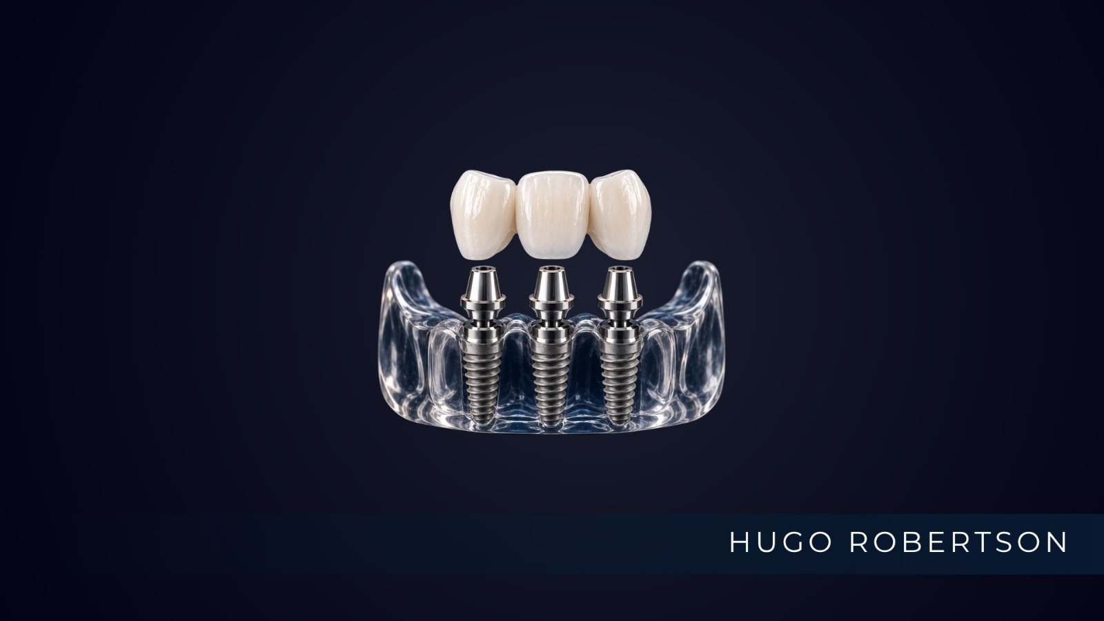 implante 3 dentes dr hugo robertson