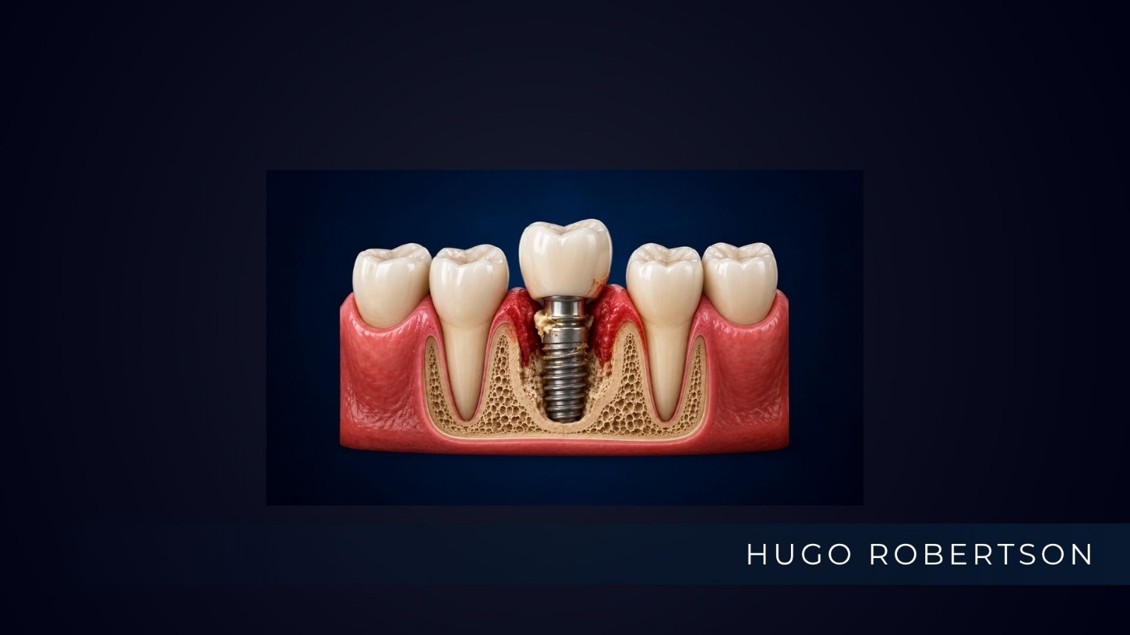 dr hugo robertson implante com peri-implantite