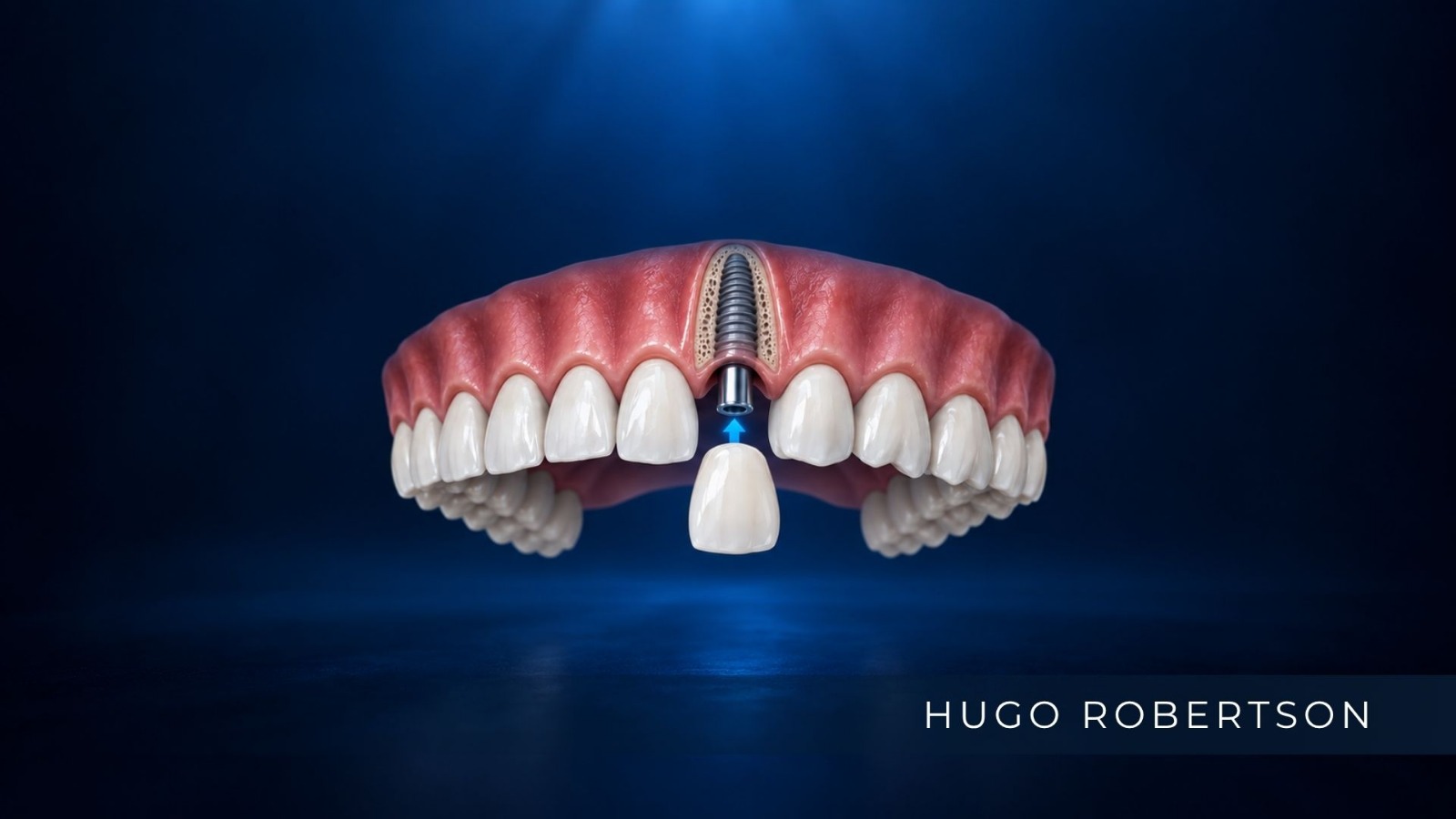 dr hugo robertson implante imediato