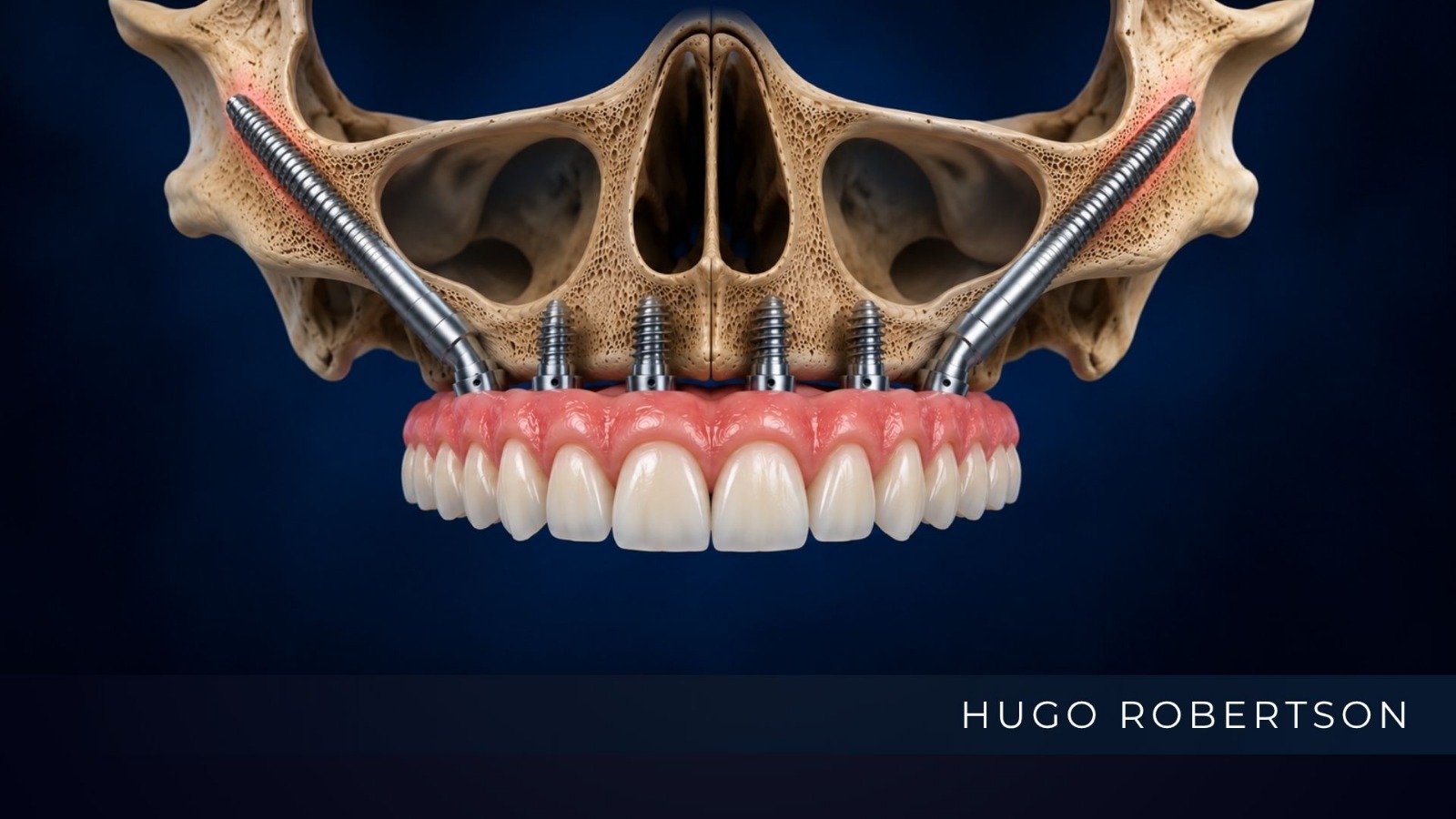 dr hugo robertson implante zigomático