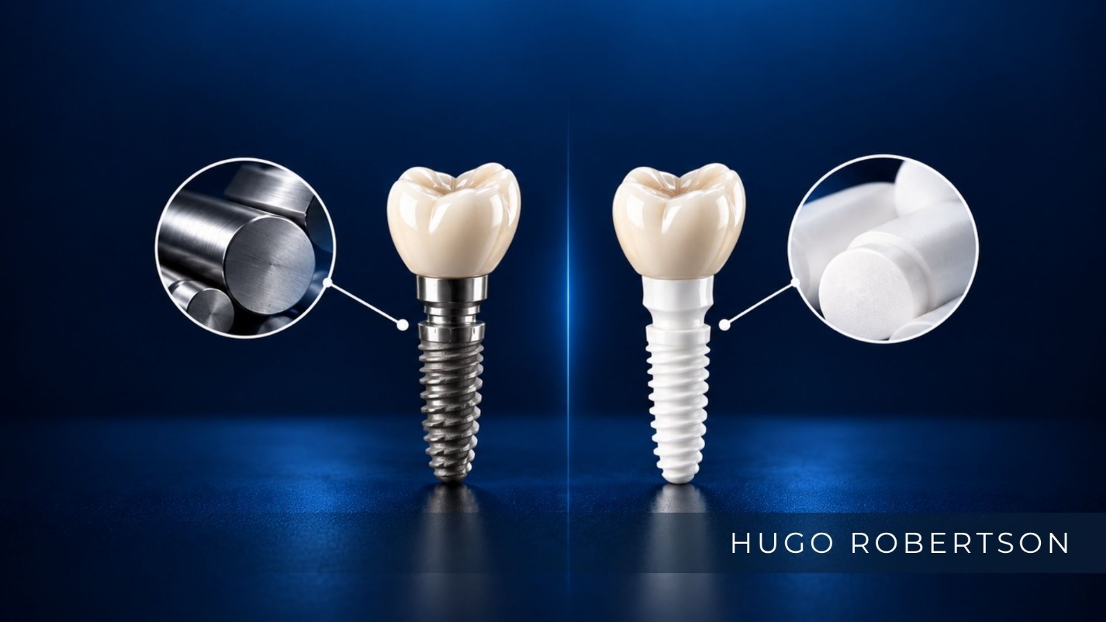 Titânio ou zircônia: o que a evidência diz sobre implantes