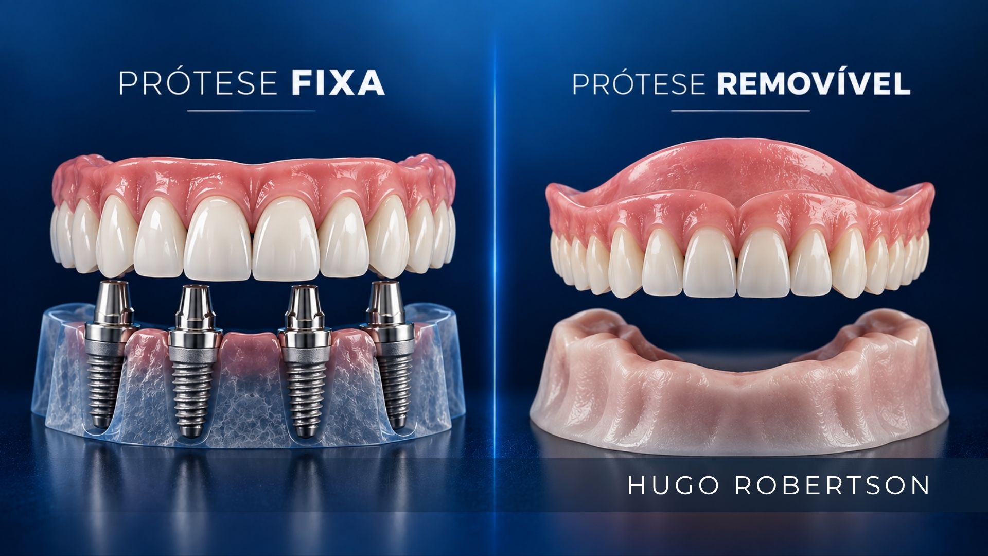 dr hugo robertson prótese fixa x prótese removível