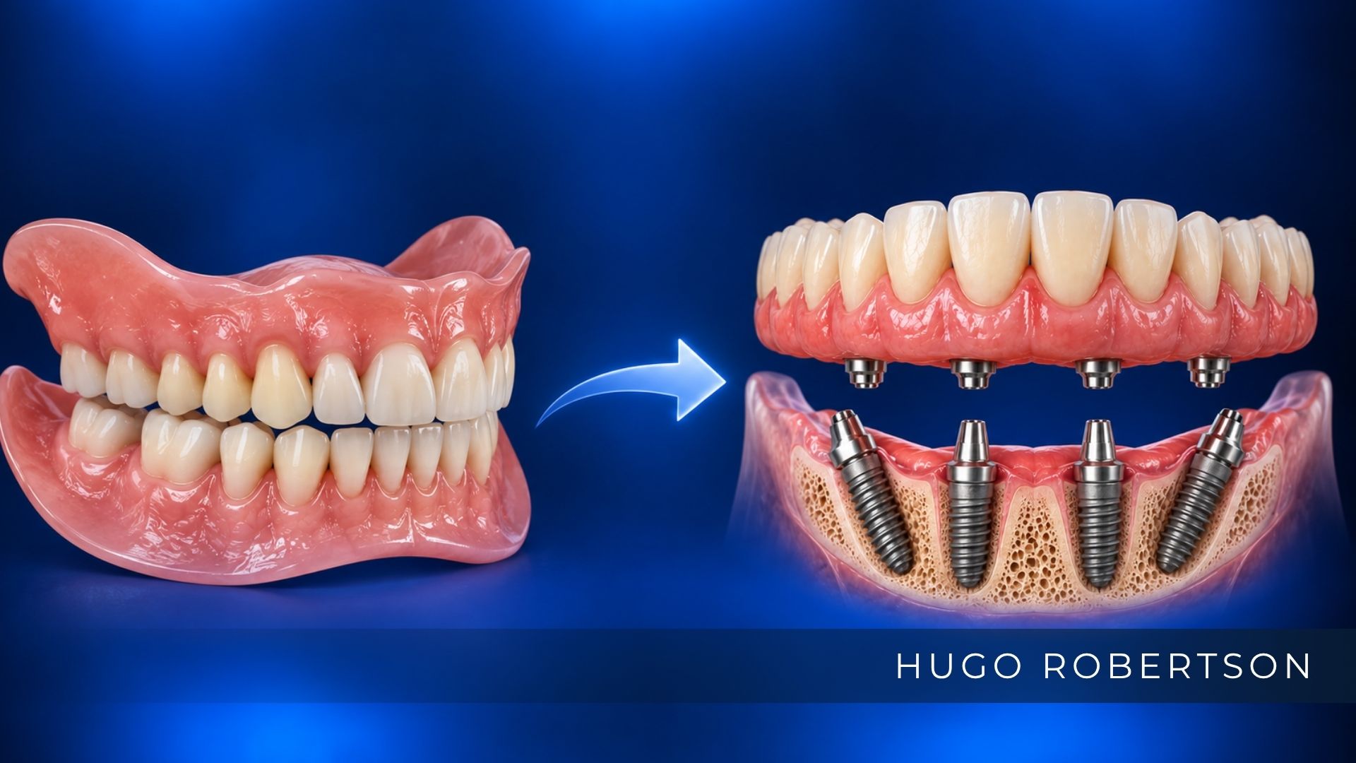 dentadura fixa X protocolo
